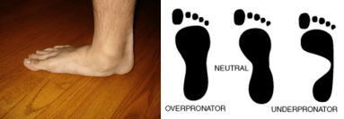 Links: ernstige platvoet - Rechts: schema platvoet - neutrale voet- holvoet