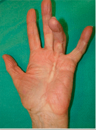 Optimaal Viva Laatste Strengen in de hand: ziekte van Dupuytren - Hand - Orthopedie Herentals