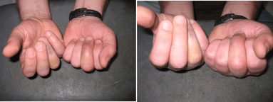 Klinische illustratie van een draaifout waarbij de gebroken ringvinger onder de middenvinger draait.