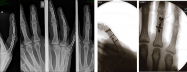 RX voor en na de operatieve behandeling van de gedraaide ringvinger breuk, waarvan hogerop een klinische foto getoond is.