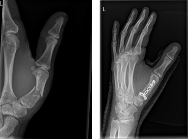 Radiografie van een patiënt waarbij een plaat en schroefjes nodig waren om de stukken van de breuk van het eerste middenhandsbeentje op de goede positie te plaatsen