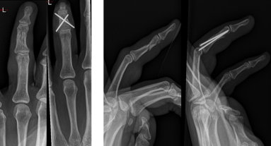 Radiografie van een patiënt waarbij een pinning van het tweede vingerkootje nodig was om de stukken van de breuk in de juiste positie te houden