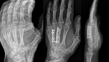 RX van een hand waarbij 2 middenhandsbeenderen gebroken waren. Behandeling met plaat en schroeven na reductie.