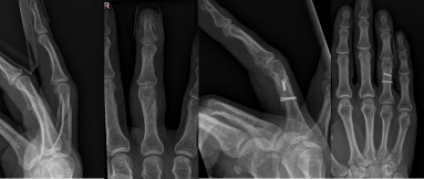 RX van een hand waarbij het eerste handkootje gebroken was Behandeling met enkel 2 schroefjes na reductie.