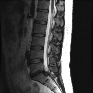 Figuur: T2 MRI: grote afdalende hernia L5-S1