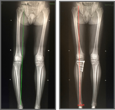 Links: O-been voor de ingreep Rechts: recht been ( in zeer licht X-stand) na de ingreep