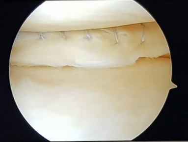 Hechting van meniscus