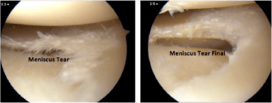 Links: degeneratieve meniscusscheur, Rechts: na gedeeltelijke wegname van meniscus