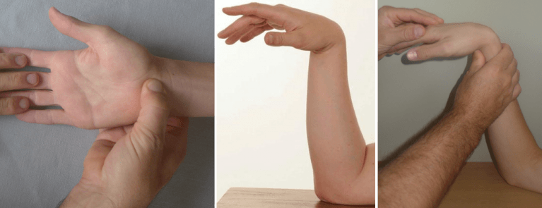 Carpaal syndroom - vingers - Hand - Orthopedie Herentals