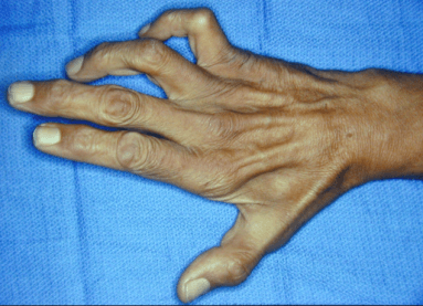 poort knoop Nevelig Cubital tunnel syndroom - Slapende vingers - Hand - Orthopedie Herentals