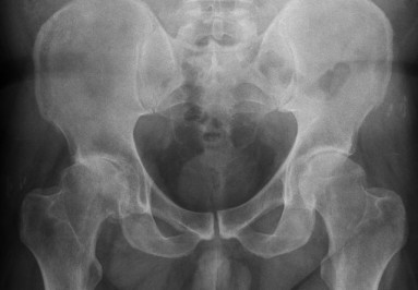 Röntgenfoto van een heup met heupartrose