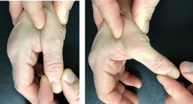 Als de hoek tussen het middenhandsbeen en het vingerkootje meer dan 30° is of meer dan 15 ° in vergelijking tot de niet gekwetste kant, en vooral als bij deze test geen harde eindstop gevoeld wordt, dan is er een volledige scheur