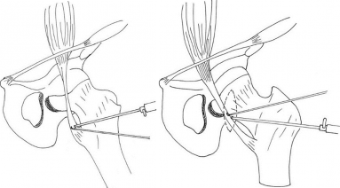 Operatie bursitis iliopsoas: kijkoperatie, verlengen iliopsoas pees + verwijderen bursa