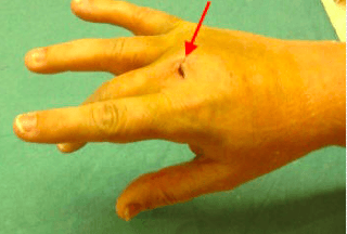 Snijwonde op de handrug, waarbij de strekpees van de middenvinger beschadigd is. De middenvinger kan niet meer gestrekt worden. 
