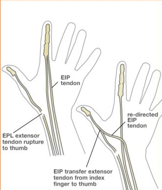 Schematische weergave van een operatieve techniek waarbij een van de strekpezen van de wijsvinger gebruikt wordt om de strekfunctie van de duim te herstellen.