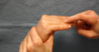 Tijdens het klinisch onderzoek wordt u gevraagd om de vinger tegen weerstand te strekken om zo verminderde strekkracht en mogelijk peesletsel op te sporen. 