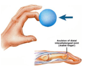 Illustratie van een letsel van de strekpees van de vinger op de plaats waar deze aanhecht aan het verste kootje van de vinger, de zogenaamde Mallet vinger