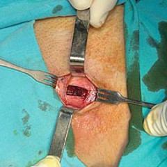 Operatie liespijn: verlengen adductoren via kleine incisie in huid
