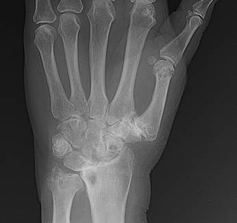 Radiografie van een patiënt met een polsarthrose