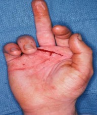 Voorbeeld van een snijwonde in de palmzijde van de middenvinger
